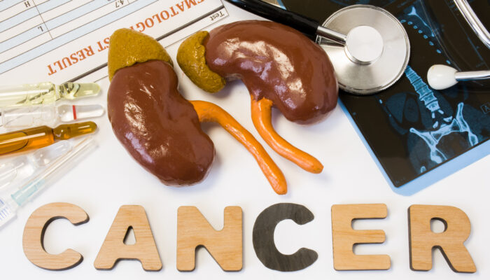 Treating Kidney Cancer